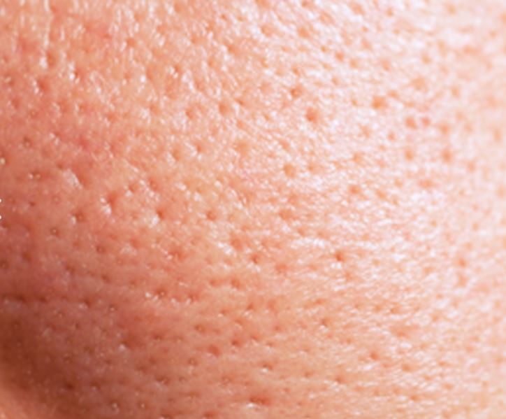 Open Pore